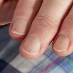 Splinter haemorrhages 3712999