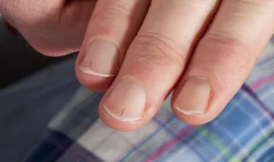 Read more about the article High cholesterol: The sign in your nails warning that levels are dangerously high