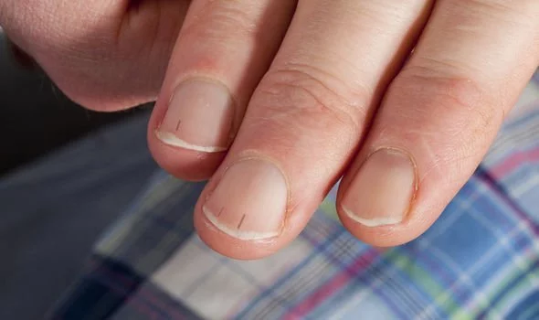You are currently viewing High cholesterol: The sign in your nails warning that levels are dangerously high
