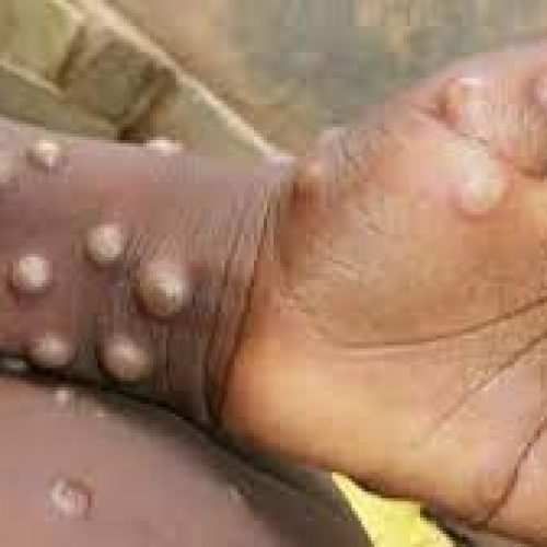 Monkeypox outbreak: Scientists probing transmission via sex