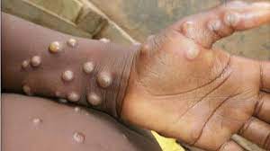 Read more about the article Monkeypox outbreak: Scientists probing transmission via sex