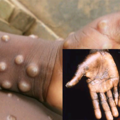 Monkeypox: Nigeria reports six cases, one death