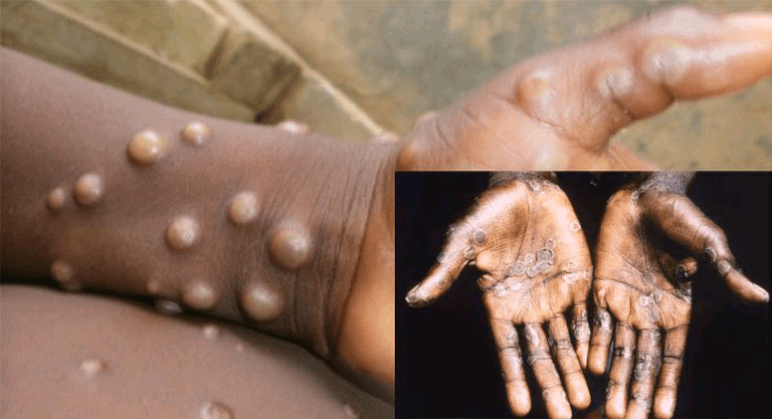 You are currently viewing Monkeypox: Nigeria reports six cases, one death