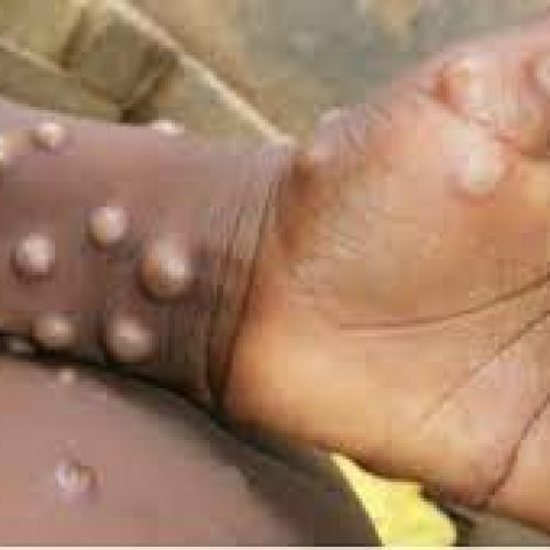 WHO confirms 3,200 cases of monkeypox in Nigeria, 47 other countries