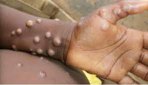 Read more about the article WHO confirms 3,200 cases of monkeypox in Nigeria, 47 other countries
