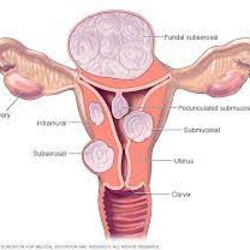 How to prevent death from fibroids –Expert