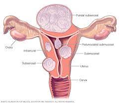 Read more about the article How to prevent death from fibroids –Expert