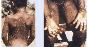 Read more about the article Lagos leads as monkeypox spreads to 26 states