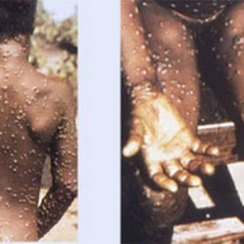 Lagos leads as monkeypox spreads to 26 states