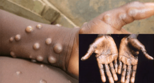 Read more about the article Monkeypox spreads to 27 states, cases hit 172