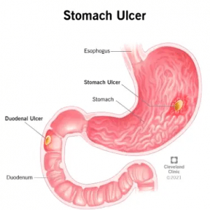 Why stomach ulcers persist among Nigerians 3 image 13