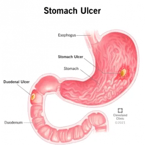 Why stomach ulcers persist among Nigerians
