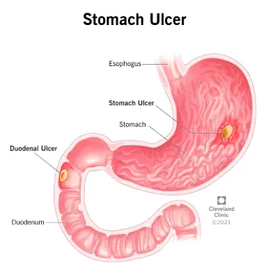 You are currently viewing Why stomach ulcers persist among Nigerians