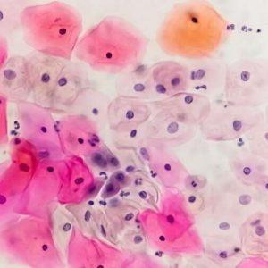 230413 hpv pap smear se 427p bda08a 1