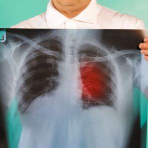 0 Patient examining x ray of lung cancer