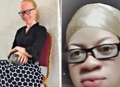 Read more about the article Albinism group seeks action against discrimination