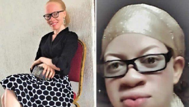 You are currently viewing Albinism group seeks action against discrimination