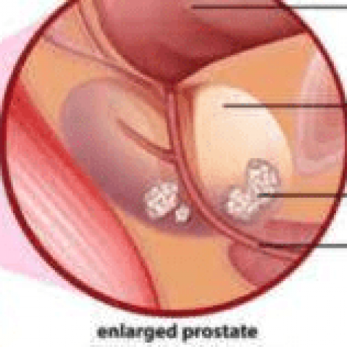 Men who engage in regular sex have low prostate cancer risk – Experts