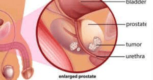 Read more about the article Men who engage in regular sex have low prostate cancer risk – Experts
