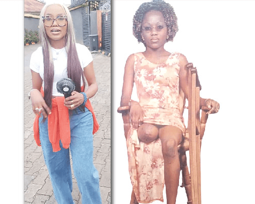 Read more about the article How I became an amputee two days after my birthday – Businesswoman