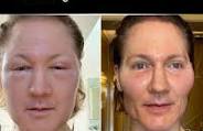 Read more about the article Bio-Hacking Tech Millionaire Bryan Johnson’s Face ‘Blows Up’ After Facial Fat Procedure: Here’s What Went Wrong
