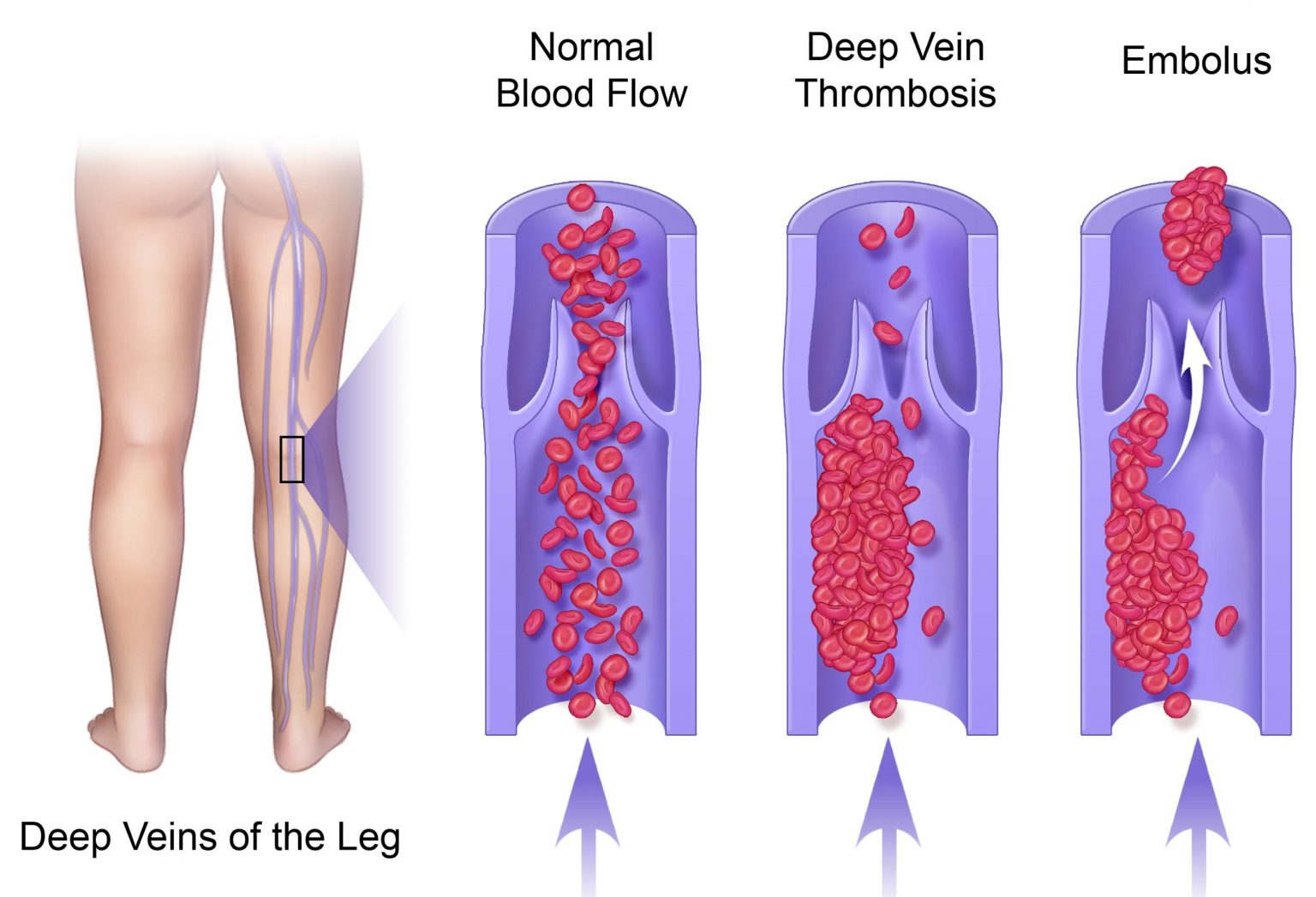 You are currently viewing Deep vein thrombosis (DVT)