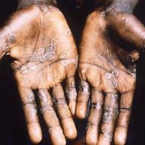 Important Things To Note About Mpox And How to Protect Yourself