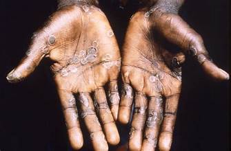 Read more about the article Important Things To Note About Mpox And How to Protect Yourself