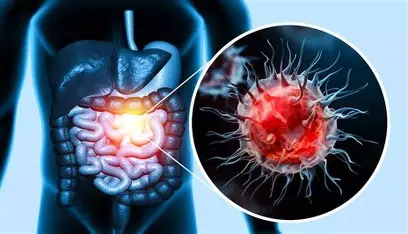 Read more about the article Colon Cancer Symptoms that Often Appear Without Pain