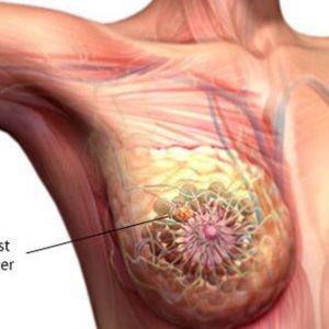 10 things about breast cancer s2 what is breast cancer
